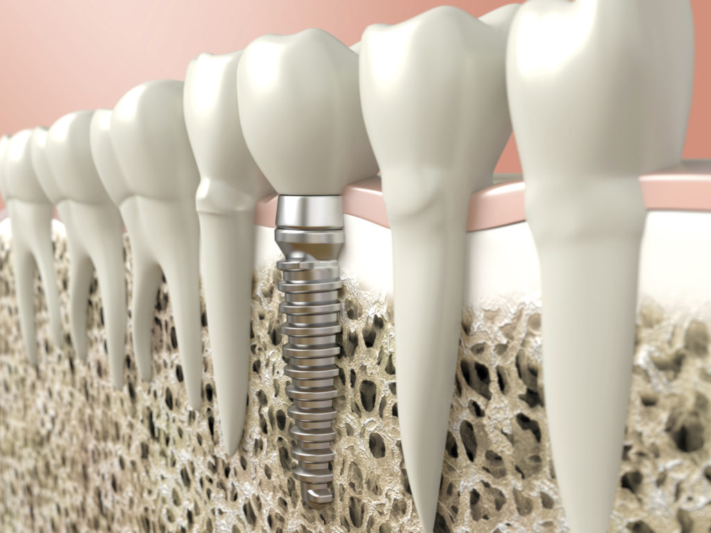 Dental Implants Aberdeen NC Teeth Implants Tooth Implant