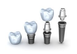Affordable dental implants in Pinehurst, North Carolina