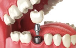 dental implants in pinehurst, NC with implant dentist