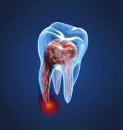 Do You Know the Periodontal Disease Warning Signs?