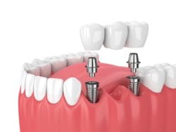single dental implants in Pinehurst North Carolina