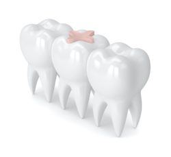 treat cavities with dental fillings