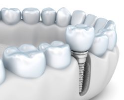 benefits of implant dentistry