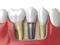 What Makes a Dental Implant Durable